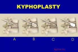 Kyphoplasty vs. Vertebroplasty: How Are They Different?